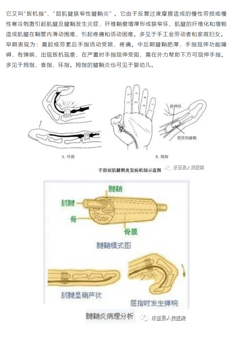 【特色治疗】小妙招解决您的“弹响指”_02.jpg